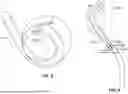 Fig. 06 - CORKSCREW SHAPE FOR RIGHT-SIDED CARDIAC DEVICE