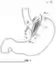 Fig. 02 - INTRALUMINAL DEVICE AND METHOD OF APPLYING STRESS TO BARORECEPTORS IN THE GASTRO-INTESTINAL TRACT