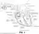 Fig. 02 - ADAPTIVE CARDIAC CONDUCTION SYSTEM PACING THERAPY FOR SINGLE-CHAMBER DEVICES
