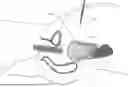 Fig. 01 - TISSUE EXTRACTION DEVICES AND RELATED METHODS