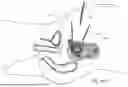 Fig. 80 - TISSUE EXTRACTION DEVICES AND RELATED METHODS