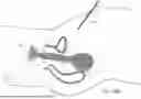 Fig. 85 - TISSUE EXTRACTION DEVICES AND RELATED METHODS