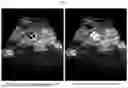 Fig. 06 - SHOCK WAVE LITHOTRIPSY DEVICE HAVING BREATHING TRIGGER FUNCTION