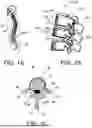 Fig. 02 - DEVICES AND METHODS FOR SPINAL IMPLANT REMOVAL