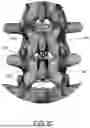 Fig. 04 - DEVICES AND METHODS FOR SPINAL IMPLANT REMOVAL
