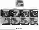 Fig. 07 - APPARATUS AND METHOD OF DETERMINING A CARDIAC IMPLANT SIZE