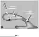 Fig. 02 - METHODS AND SYSTEMS FOR TREATMENT OF CEREBRAL EDEMA