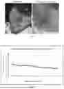 Fig. 12 - METHOD OF TREATING GOUT BY TOPICAL APPLICATION OF NANO LINIMENT