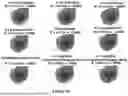 Fig. 12 - Order-based Diagnosis of Cervical Cancers
