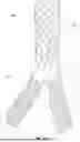 Fig. 02 - APPARATUSES AND METHODS FOR EXPANDABLE BRANCHING STENT PROSTHESES