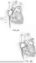 Fig. 11 - ASPIRATION CATHETER SYSTEMS