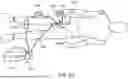 Fig. 14 - ASPIRATION CATHETER SYSTEMS
