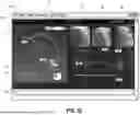 Fig. 06 - THREE-DIMENSIONAL SIZING TOOL FOR CARDIAC ASSESSMENT