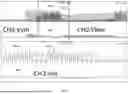 Fig. 06 - Switching Mode Power Supply with Single Power Line Detection Circuit