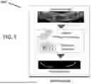 Fig. 06 - MANDIBULAR CANAL DETECTION
