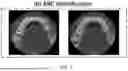 Fig. 08 - MANDIBULAR CANAL DETECTION