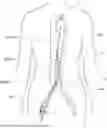 Fig. 01 - Devices and Method for Blood Vessel Occlusion