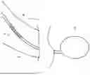 Fig. 07 - SYSTEMS AND METHODS FOR REMOVING A HYDROGEL IMPLANT FROM A BODY LUMEN