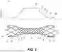 Fig. 04 - METHODS AND SYSTEMS FOR AN INTRACRANIAL STENT
