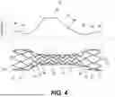 Fig. 05 - METHODS AND SYSTEMS FOR AN INTRACRANIAL STENT