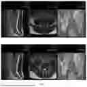 Fig. 02 - METHOD FOR TREATMENT OF LUMBAR INTERVERTEBRAL HERNIAS