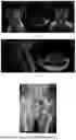 Fig. 07 - METHOD FOR TREATMENT OF LUMBAR INTERVERTEBRAL HERNIAS