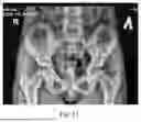 Fig. 08 - METHOD FOR TREATMENT OF LUMBAR INTERVERTEBRAL HERNIAS