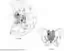 Fig. 14 - FACET JOINT FIXATION DEVICE