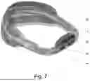 Fig. 07 - CRANIAL ORTHOSIS AND METHOD THEREFOR