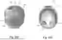 Fig. 30 - CRANIAL ORTHOSIS AND METHOD THEREFOR