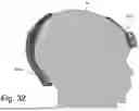 Fig. 38 - CRANIAL ORTHOSIS AND METHOD THEREFOR