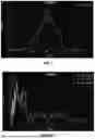 Fig. 07 - CYCLE LENGTH MAPPING FOR TREATING ATRIAL FIBRILLATION