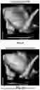 Fig. 08 - CYCLE LENGTH MAPPING FOR TREATING ATRIAL FIBRILLATION