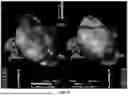Fig. 09 - CYCLE LENGTH MAPPING FOR TREATING ATRIAL FIBRILLATION
