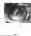 Fig. 04 - Devices And Methods For Occluding Abnormal Openings In A Patient's Vasculature