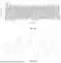 Fig. 48 - SYSTEM, DEVICES AND METHODS FOR REMOVING OBSTRUCTIONS IN BODY LUMENS