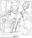 Fig. 07 - METHOD OF PERFORMING A MINIMALLY INVASIVE SPINAL SURGERY UTILIZING PEDICLE SCREW CORRIDORS