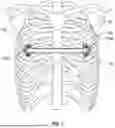 Fig. 02 - PECTUS BAR AND STABILIZER DEVICES AND METHODS