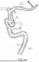 Fig. 08 - METHODS AND DEVICES FOR TREATING VASCULAR DISEASE