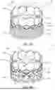 Fig. 02 - LEAFLETS WITH POLYMERIC TISSUE-ADHERENT SURFACES