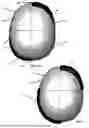 Fig. 06 - CRANIAL REMODELING ORTHOSIS MODEL