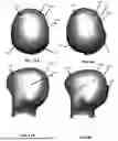 Fig. 07 - CRANIAL REMODELING ORTHOSIS MODEL
