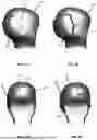 Fig. 08 - CRANIAL REMODELING ORTHOSIS MODEL